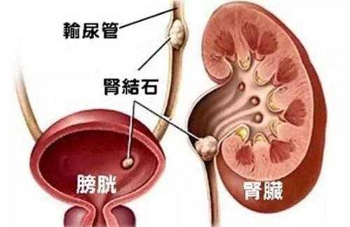 肾结石在肾里疼怎么办 为什么肾结石有肾区叩击痛